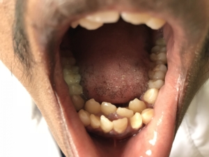 Tooth Anomalies