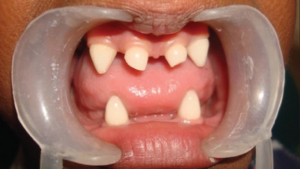 Teeth Anomalies