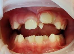 Teeth Anomalies